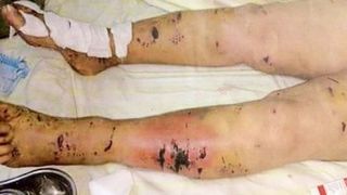 Elena Tudosa a stat in spital 85 de zile, dupa ce a fost sfasiata de o haita de caini. Femeia cere sa i se faca dreptate si da in judecata Primaria din Iasi