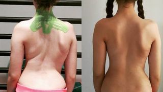 Aureliana este pe drumul cel bun, corsetele o ajuta si coloana a inceput sa se indrepte