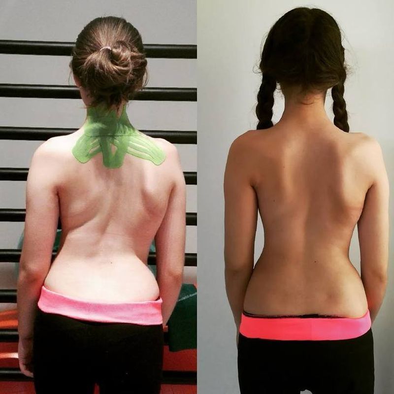 Aureliana este pe drumul cel bun, corsetele o ajuta si coloana a inceput sa se indrepte