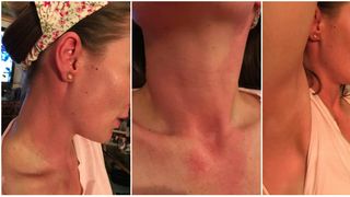 Asa arata corpul unei jurnaliste din Romania dupa ce a fost GAZATA in Piata Victoriei! "Aveam frisoane si puls 130. A trebuit sa ma misc incontinuu o noapte intreaga pentru a nu urla de durere!"