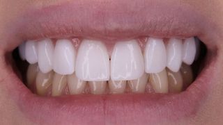 Ultima moda printre tepari: fatetele dentare! Atrasi de mirajul preturilor mici, sute de credului cad in plasa sarlatanilor