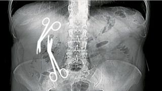 Caz medical şocant! Un cunoscut chirurg din Constanţa a uitat două perechi de foarfece &icirc;n abdomenul unei femei
