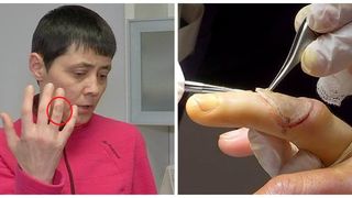 Una din trei persoane cu cancer este diagnosticată  cu o formă de cancer de piele. Cum puteţi preveni la timp această boală necruţătoare