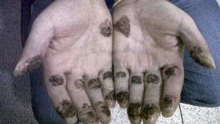 Asa arata mainile lui "El Loco" dupa ce si-a turnat acid sulfuric pentru a-si distruge amprentele
