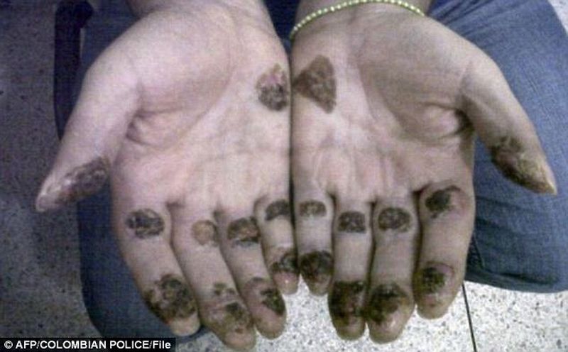 Asa arata mainile lui "El Loco" dupa ce si-a turnat acid sulfuric pentru a-si distruge amprentele