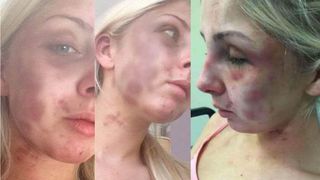 Fostul iubit a incuiat-o in casa si a batut-o 4 ore cu bestialitate! Tanara, de 19 ani, a postat pe internet poze cu ea plina de vanatai. Imagini cu un puternic impact emotional