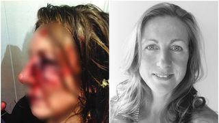 Cosmarul de necrezut prin care a trecut o femeie. A fost batuta crunt de un hot, pentru ca a refuzat sa intretina relatii sexuale cu el. Marturii cutremuratoare