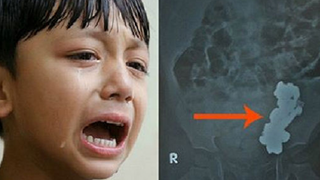 Un baietel de 3 ani plangea ca il doare burta! Medicii au ramas socati dupa ce i-au facut ecografia - Ce avea in stomac