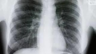 Un nigerian a fost prins in Franta cu 79.000 de euro in intestine