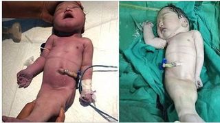 O femeie de 23 de ani a nascut o "sirena"