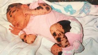 S-a nascut cu o boala rara de piele si i se spune "Dalmatianca". Cum arata acum tanara la 19 ani