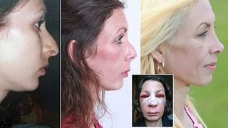 Si-a operat nasul de trei ori si si-a pierdut jobul, prietenii si sotul. "Interventiile estetice mi-au distrus viata"