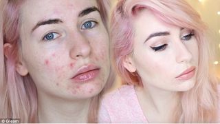 O bloggerita de beauty, care sufera de acnee de 10 ani, a decis sa isi filmeze fata in fiecare zi. Un jurnal video emotionant
