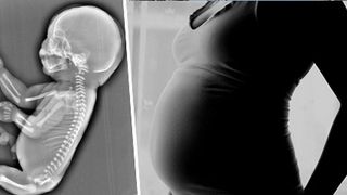 O femeie insarcinata in 6 luni a decis sa faca avort, dupa ce medicii i-au spus ca bebelusul pe care il poarta in pantec are o coada, in loc de picioare. Fetusul suferea de sirenomelie