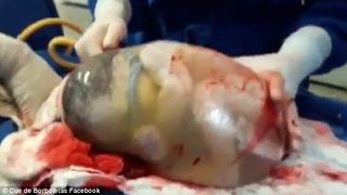 Momentul incredibil in care un bebelus a fost nascut in sacul amniotic. Doar unul din 80.000 de copii vin pe lume asa