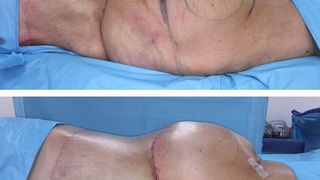 Un chirug posteaza fotografii pe Instagram cu pacientele sale inainte si dupa operatiile estetice la fund. Transformarile sunt incredibile