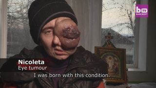 Drama Nicoletei, o tanara de 28 de ani din Selistea cu o tumora enorma la un ochi. Doctorii nu au idee cum ar putea sa o opereze fara sa ii puna in pericol viata