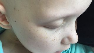 "Este singura geana care i-a mai ramas". Imaginea cu fetita de 7 ani, bolnava de cancer, care te va face sa plangi!