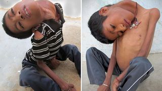 Baiatul din India care s-a nascut cu capul intors la 180 de grade a murit la opt luni dupa operatia care i-ar fi schimbat viata