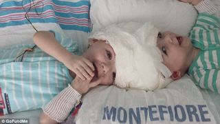 Gemeni nascuti lipiti in zona capului s-au vazut pentru prima data de la nastere. Operatia de separare a durat 27 de ore