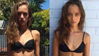 Cantarea doar 34 de kilograme: "Tatal meu a plans cand m-a vazut". Povestea tinerei care a reusit sa invinga anorexia