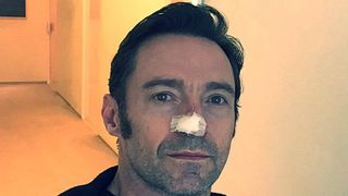 Actorul Hugh Jackman a fost operat pentru a sasea oara pentru extirparea unor celule care cauzeaza cancer de piele