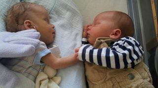 Fotografia care a emotionat o lume intreaga. Doi bebelusi se tin de manute, in timp ce unul dintre ei se lupta pentru viata