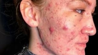 Avea chipul ciuruit de acnee, insa a reusit sa scape de cosuri cu un truc simplu: "O sa le invat pe toate fetele cum se face"