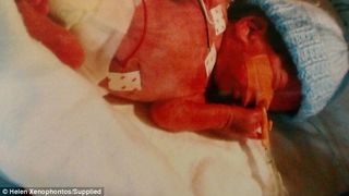 Cazul acestui bebelus a uimit lumea medicala. S-a nascut prematur, la 25 de saptamani, iar pielea lui era transparenta. Imagini unice cu micutul