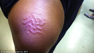 O femeie s-a intors din vacanta si a descoperit o iritatie pe picior. Medicii s-au ingrozit cand au vazut-o. A contactat o boala extrem de rara