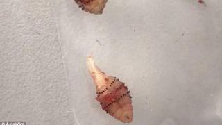 O femeie a trecut prin clipe ingrozitoare cand un vierme a iesit din genunchiul acesteia dupa o calatorie in Brazilia. Imagini teribile