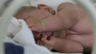 Un copil cu sindromul imbatranirii premature s-a nascut in Bangladesh. Desi are doar o zi de viata, arata ca un om foarte batran