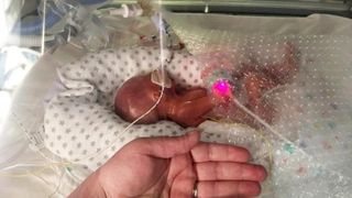 Era atat de slab incat i se vedeau organele inca neformate in totalitate. El este "copilul miracol" care cantarea doar 500 de grame la nastere