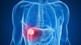 Cancerul la ficat in stadiul 4, pe intelesul tuturor! Totul despre simptomele acestei afectiuni, tratamente si sperante de viata.