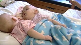 Aceste siameze au fost separate de medici in urma cu 10 ani! Cum arata fetitele acum