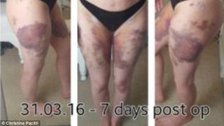 "Sunt distrusa cand ma uit in oglinda". Drama unei mame, cu trupul plin de vanatai si cu sanii taiati