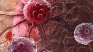 Acesta este cel mai agresiv tip de cancer. Doar 4% din pacienti ii supravietuiesc. Care sunt simptomele care te trimit de urgenta la medic