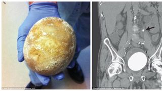 Avea dureri incredibile cand urina si s-a dus la spital. Medicii au avut un soc cand au vazut ce a avea in vezica