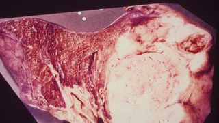 Trebuie sa stii asta! Studiu. Cum transforma fumatul celulele de la nivelul plamanilor