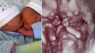 Medicii i-au spus ca gemenii ei vor muri in uter, dar ceva miraculos s-a intamplat! "S-au imbratisat unul pe altul, iar apoi..."