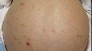 Acestea sunt simptomele cirozei hepatice, boala care  baga in pamant anual 10.000 de romani