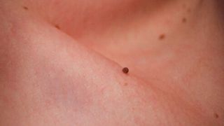 Semnele care iti arata ca o alunita este cancerigena. Trebuie sa mergi de urgenta la spital, daca le ai