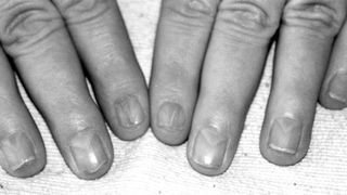 Ce inseamna daca ai lunula pe unghii asa! Atentie, trebuie imediat sa consulti un medic