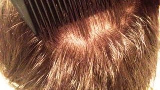 Ce inseamna daca iti apar paduchii in vis? Nu este semn de bogatie, asa cum sustine traditia populara