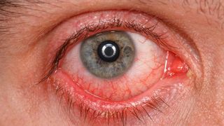 Tratamente naturiste pentru conjunctivita