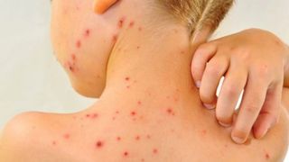 Ce e rujeola. Cum se manifesta si cum se trateaza