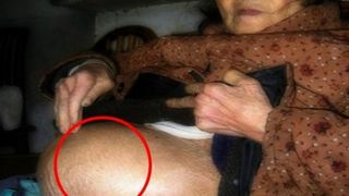 Cazul socant al femeii de 92 de ani care s-a dus la doctor pentru ca burta ei tot crestea si incepuse sa o doara. Ce au descoperit medicii este de neimaginat