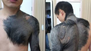 "Sindromul varcolacului" poate aparea si la oameni. Cum se manifesta aceasta boala