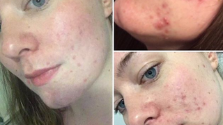 Erau pline de vergeturi si pete de la acnee, dar au dat peste un produs minune. Este isterie printre femei