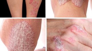 PSORIAZIS. Cum să ţii &icirc;n fr&acirc;u afecţiunea care te face să-ţi fie ruşine cu pielea ta. Remedii naturale